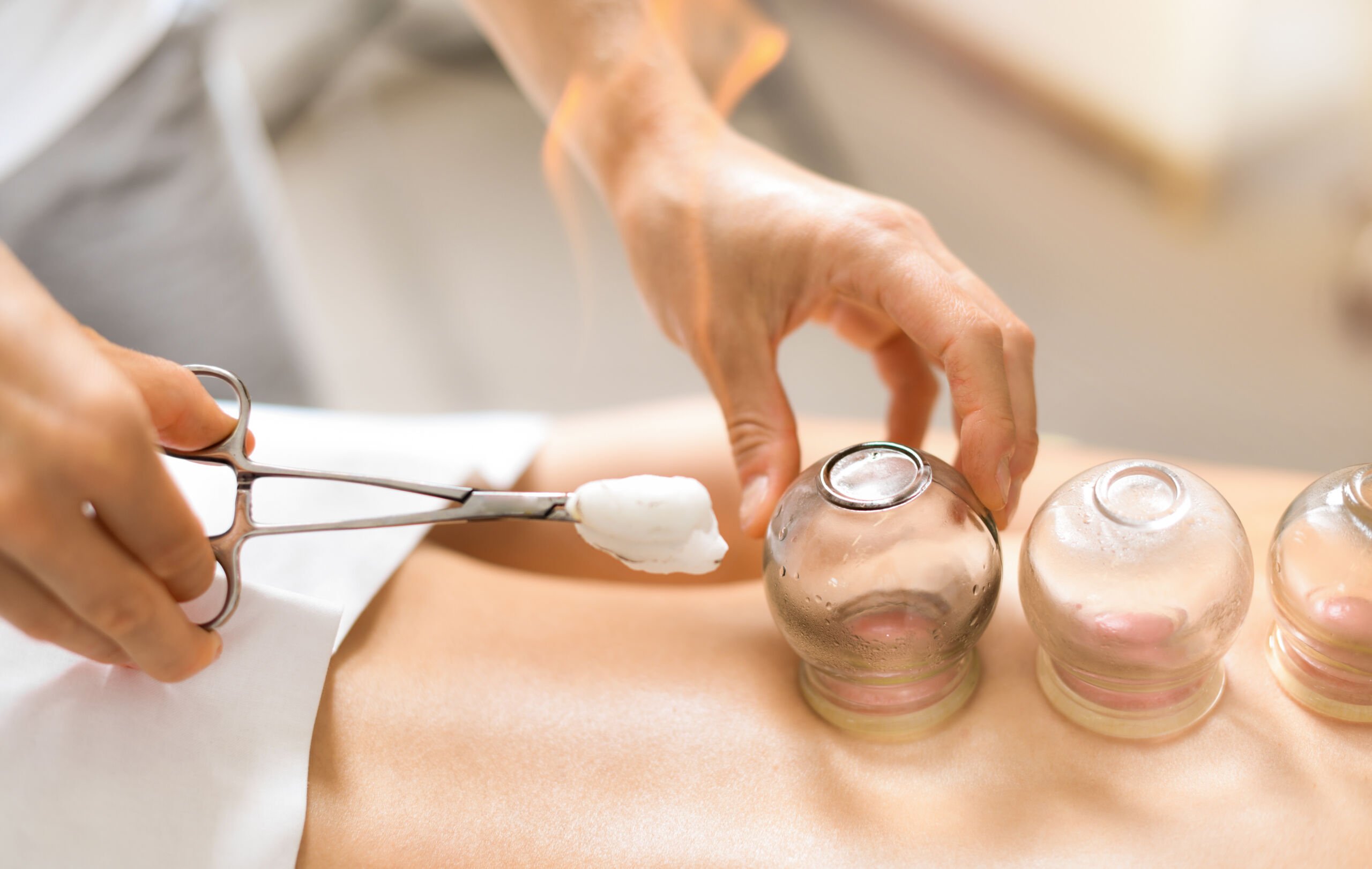 Detail of a woman therapist hands giving cupping treatment on ba